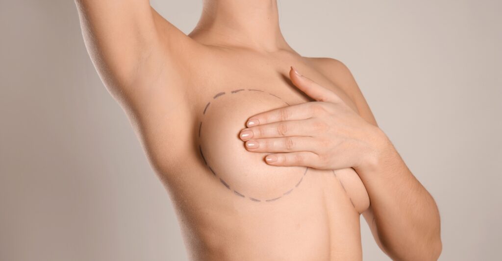 Breast Augmentation in Miami